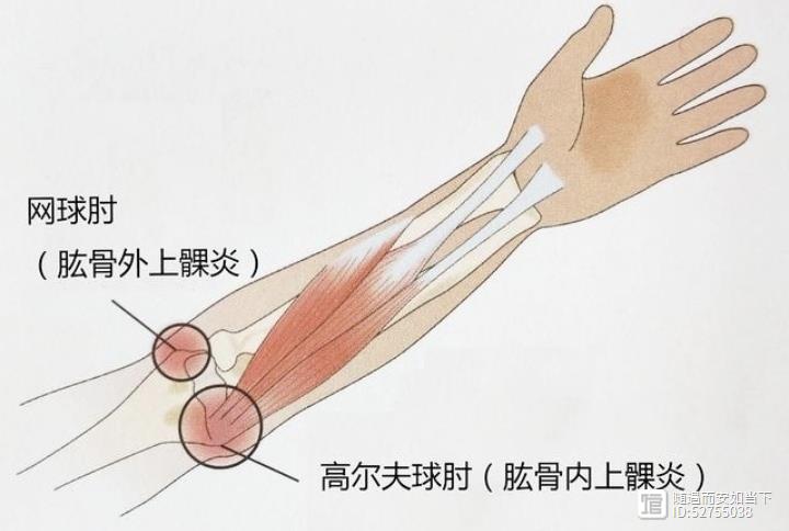 肘劳（针灸治疗）