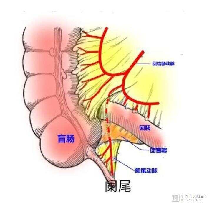 肠痈（急性阑尾炎）师承笔记