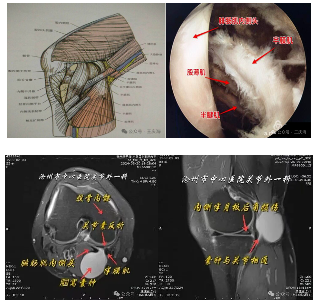 骨科精读 | 小囊肿，大烦恼：腘窝囊肿与关节镜下治疗！