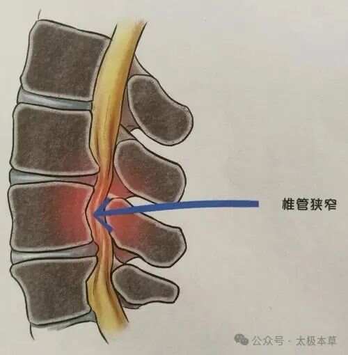 骨伤秘方，治疗腰椎管狭窄症