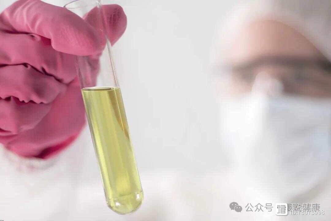 尿酸高说明得了痛风？不一定，一文告知你两者之间的关系！