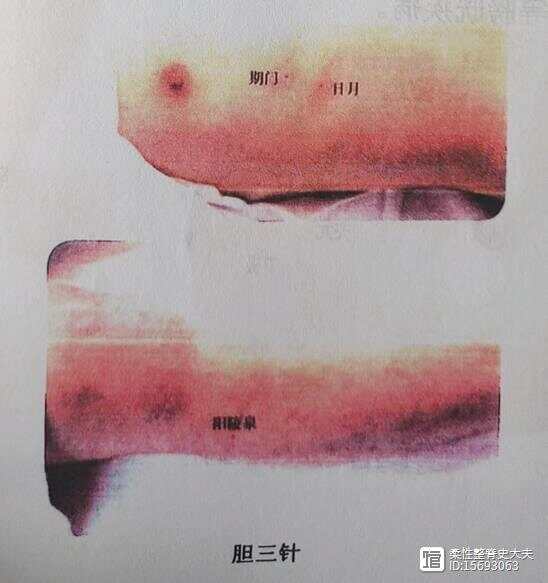 临床特效三针（一） - 健康号