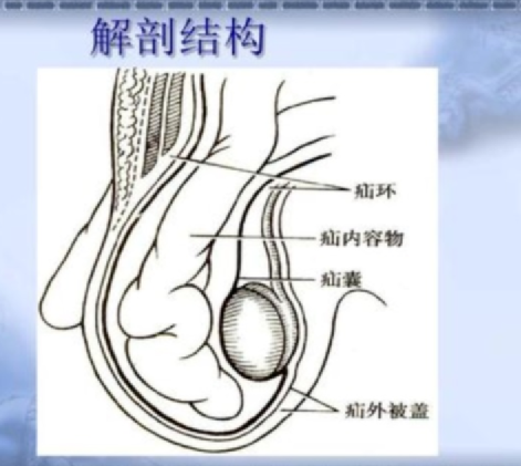 健康科普丨腹股沟疝中医治疗 三种分型要注意