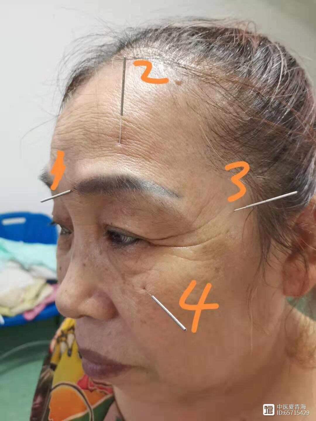 眼疾针：