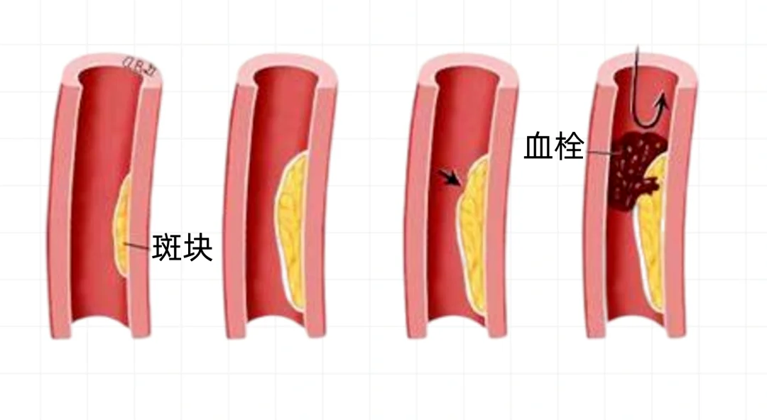 体内有血栓，手脚先知！若有这4种表现，血管可能堵塞了