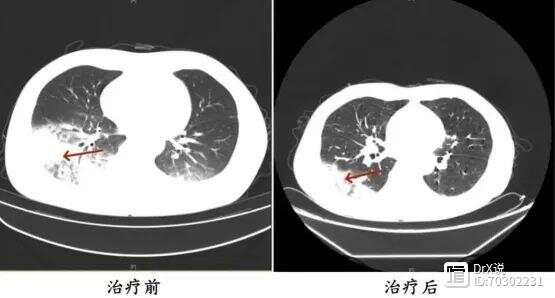 多人接连确诊，严重时可致死！现在几乎家家都在用，别再用错了！