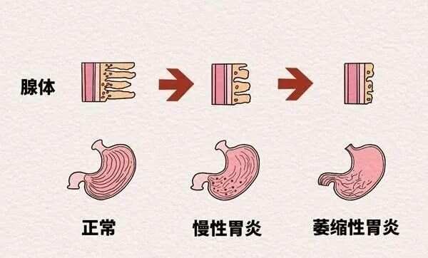 萎缩性胃炎、各类消化性溃疡用方